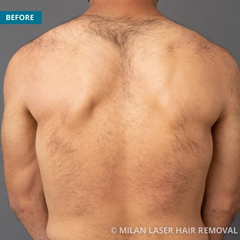 Laser hair removal deals back